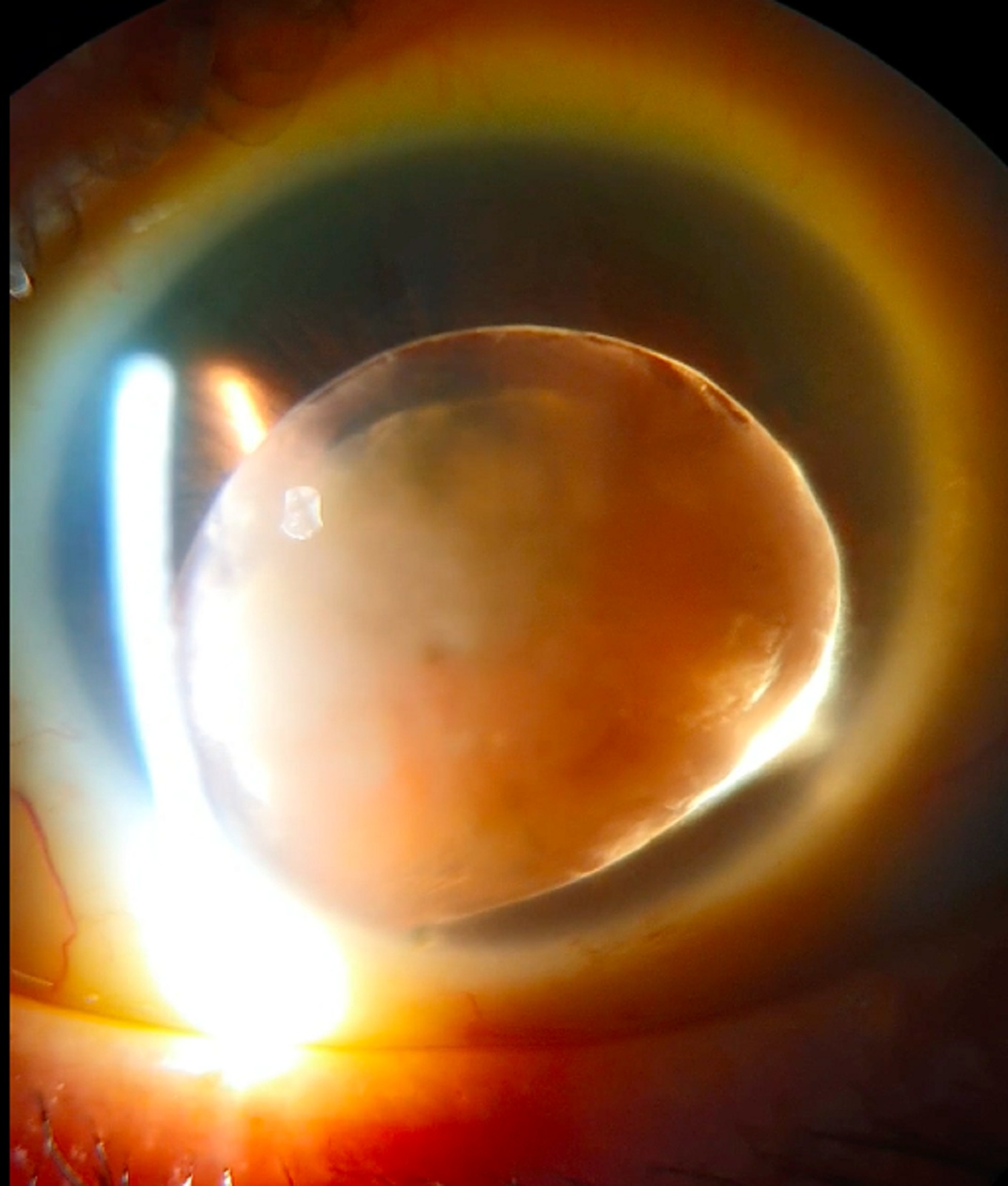 THE LENS AND ITS GOLDEN RINGS